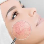 Couperosa-iho: Oireet, Hoidot, Kauneustuotteet